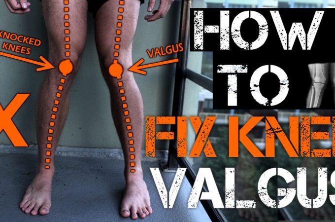 Complete Guide On The Knock Knees And Bow Legs